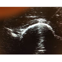 Platelet-Rich Plasma (PRP)